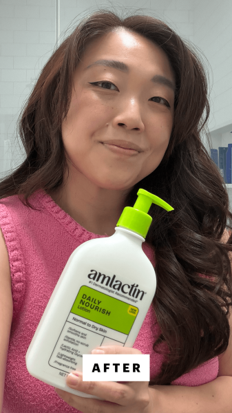 Lee after applying the AmLactin Daily 12 Lactic Acid Moisturizing Lotion
